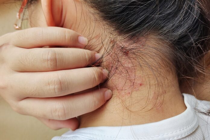 alimentacao-pode-influenciar-sintomas-da-psoriase,-aponta-estudo
