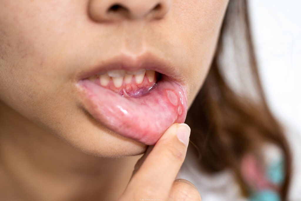 saiba-como-tratar-aftas-de-forma-caseira-e-quando-procurar-o-dentista