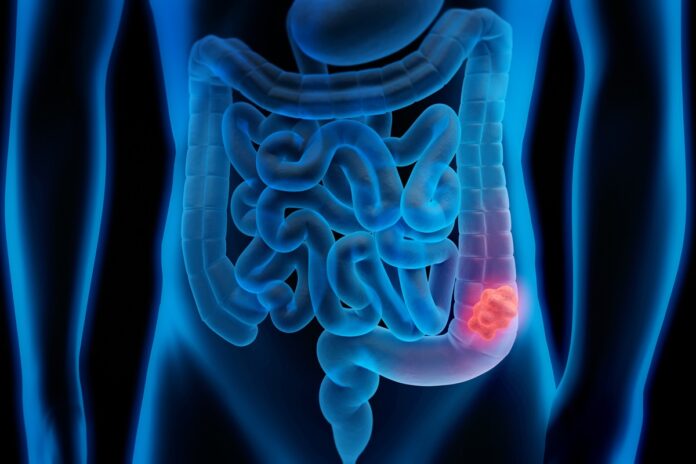 mortes-por-cancer-colorretal-devem-crescer-36%-ate-2040,-diz-estudo