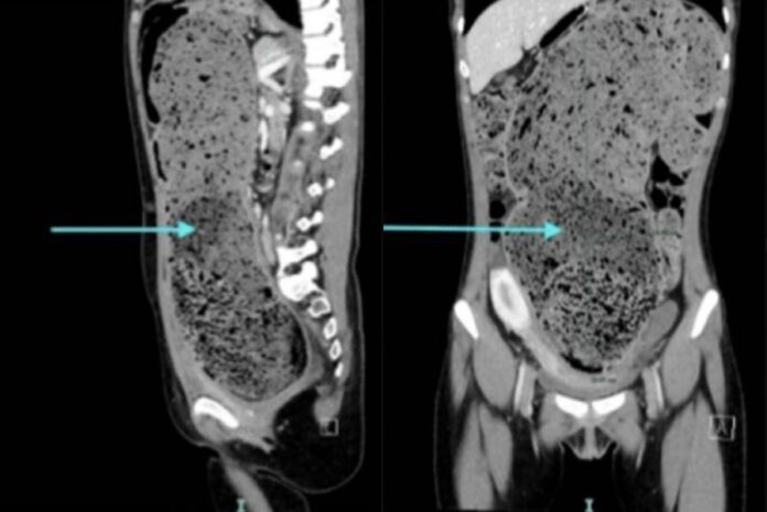 mulher-passa-quatro-meses-constipada-e-perde-4,5-kg-apos-tratamento
