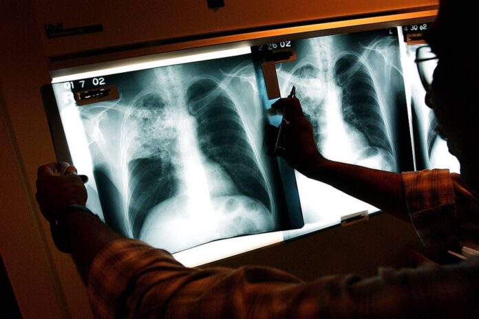 novo-teste-portatil-para-detectar-tuberculose-tem-100%-de-precisao