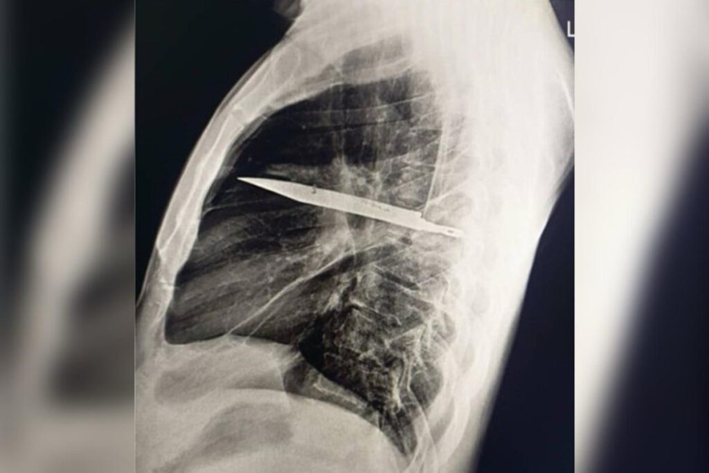 homem-sente-dor-no-peito-e-descobre-faca-alojada-no-corpo-ha-oito-anos
