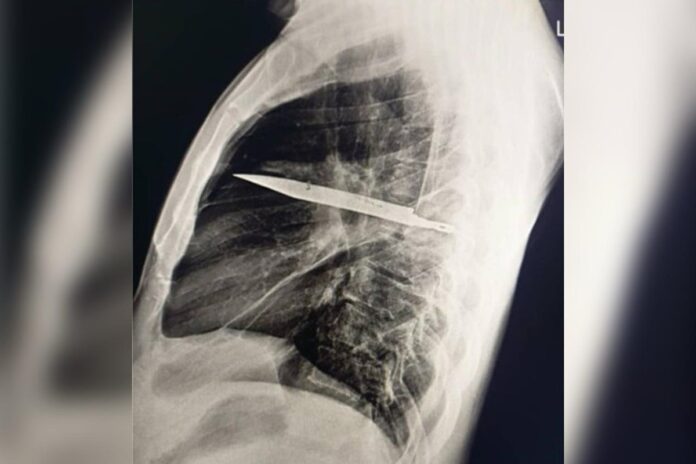 homem-sente-dor-no-peito-e-descobre-faca-alojada-no-corpo-ha-oito-anos