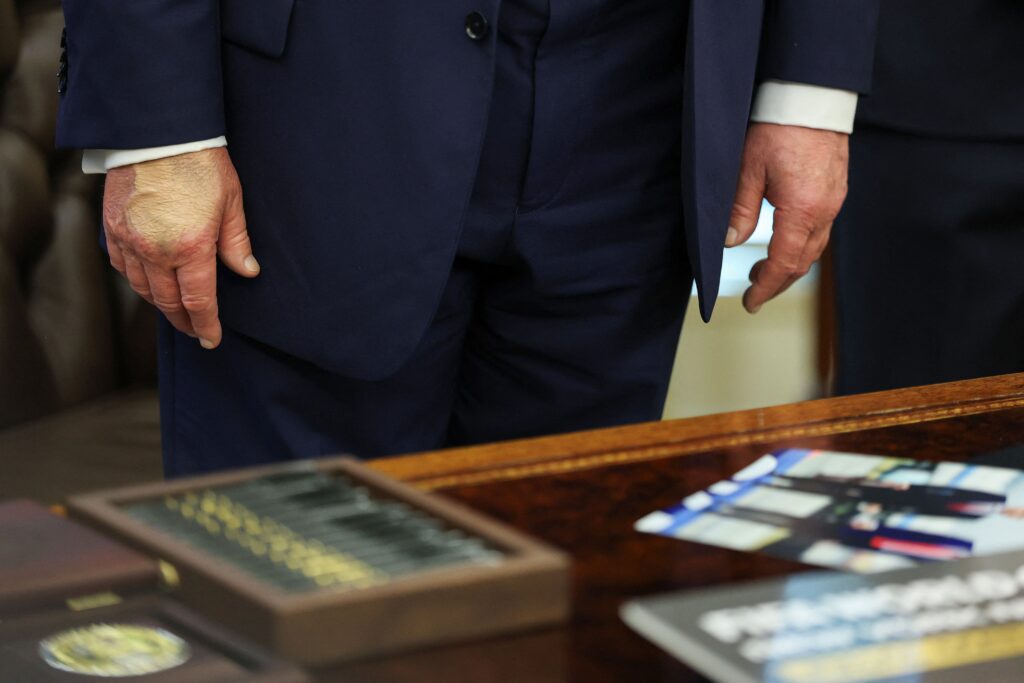 trump-reaparece-com-mao-maquiada-apos-diagnostico-de-insuficiencia-venosa