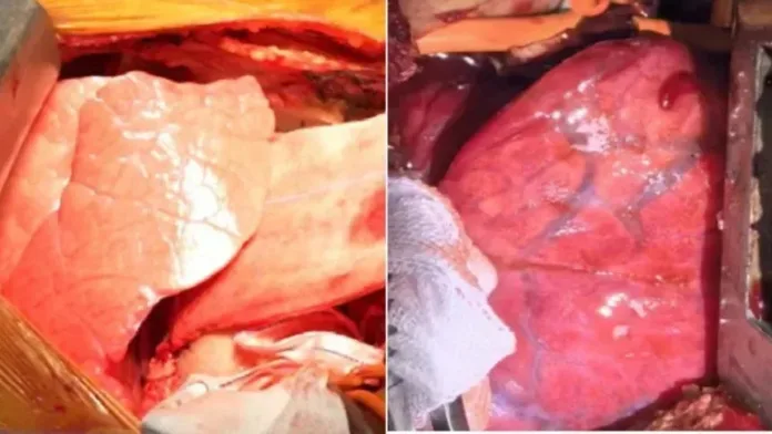 pulmao-de-porco-modificado-e-transplantado-em-homem-pela-1a-vez