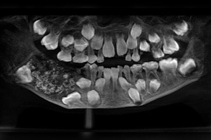 menino-de-7-anos-tem-526-dentes-retirados-em-cirurgia-na-india