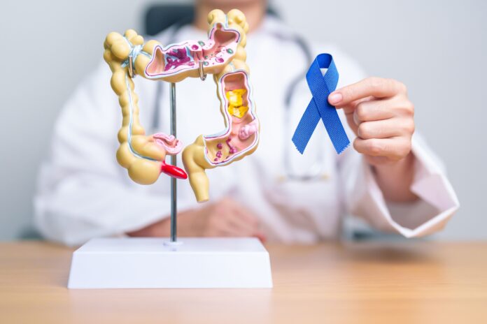 cancer-colorretal:-como-diminuir-o-risco-da-doenca
