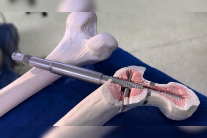 implante-inedito-desenvolvido-no-brasil-melhora-tratamento-do-femur