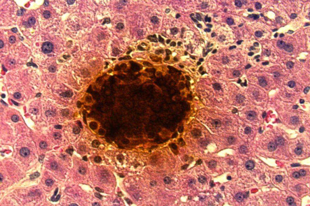 1o-transplante-com-terapia-inovadora-para-diabetes-e-realizado-nos-eua