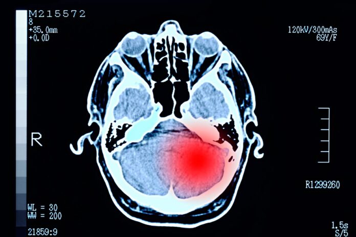 desordem-em-aneis-de-dna-revela-pistas-sobre-cancer-cerebral-agressivo