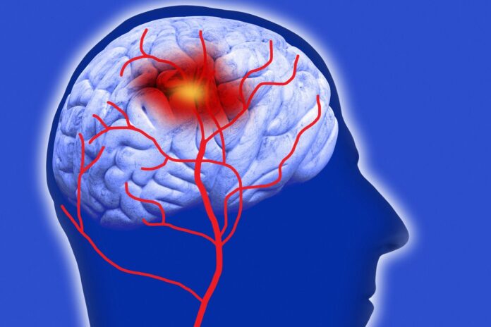 sindrome-de-moyamoya:-conheca-doenca-que-aumenta-riscos-de-avc