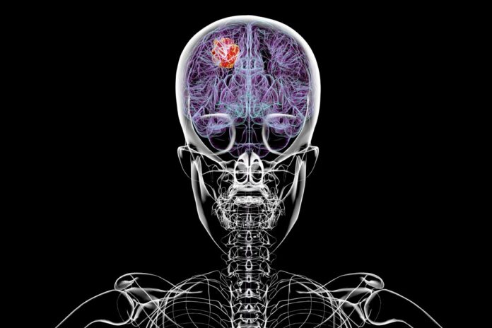 dieta-pode-melhorar-efeito-de-tratamento-contra-tumor-cerebral-grave