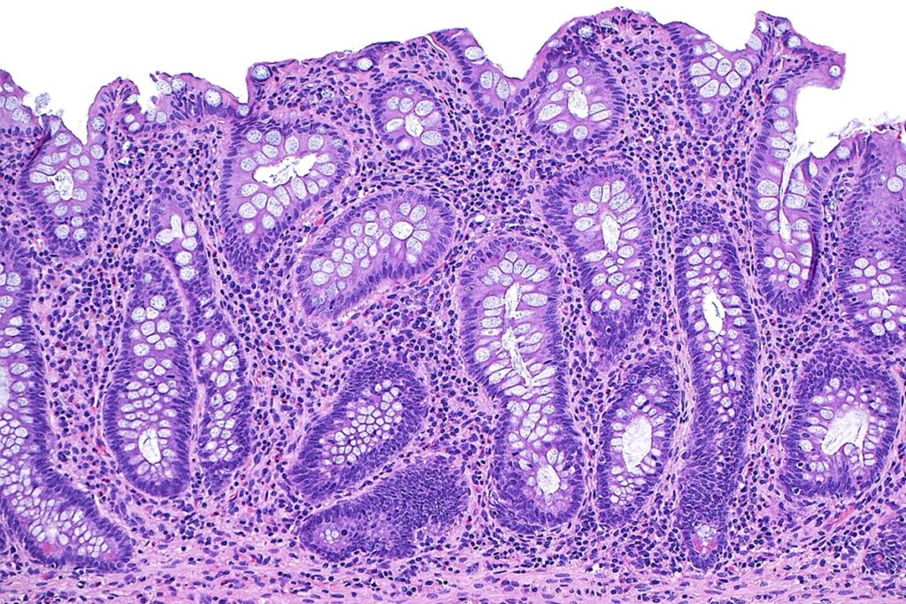 doencas-inflamatorias-intestinais-nao-sao-mais-raras-e-exigem-atencao