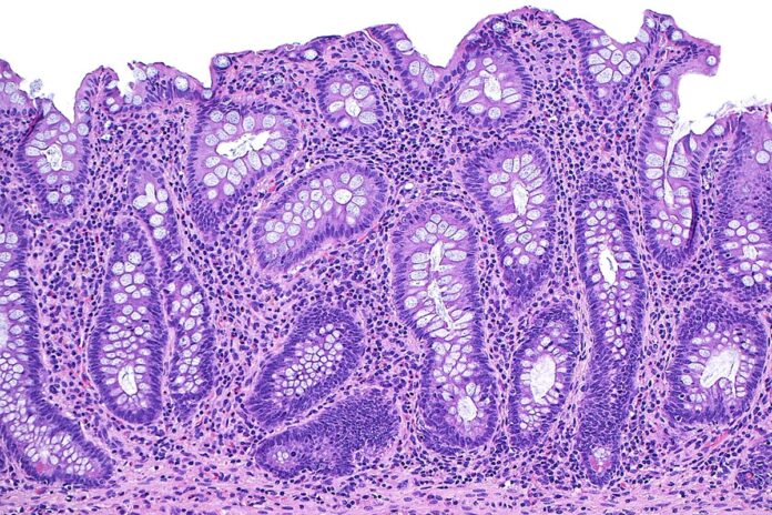 doencas-inflamatorias-intestinais-nao-sao-mais-raras-e-exigem-atencao