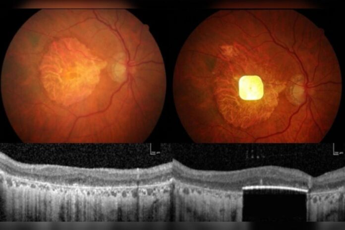 implante-de-retina-devolve-parte-da-visao-a-pessoas-com-cegueira