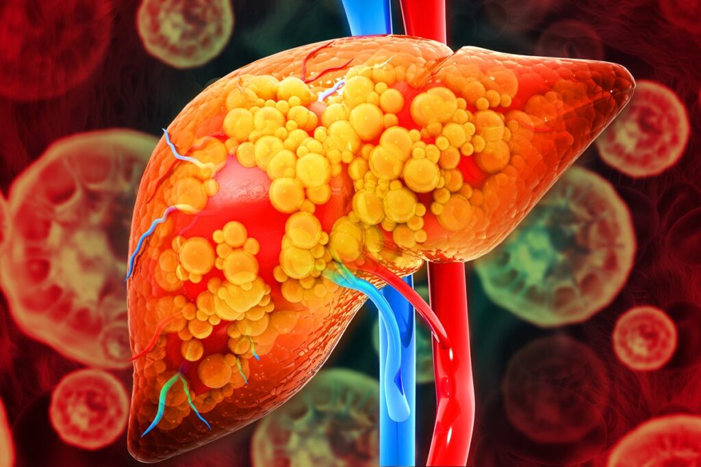 gordura-no-figado:-dicas-simples-para-evitar-a-esteatose-hepatica