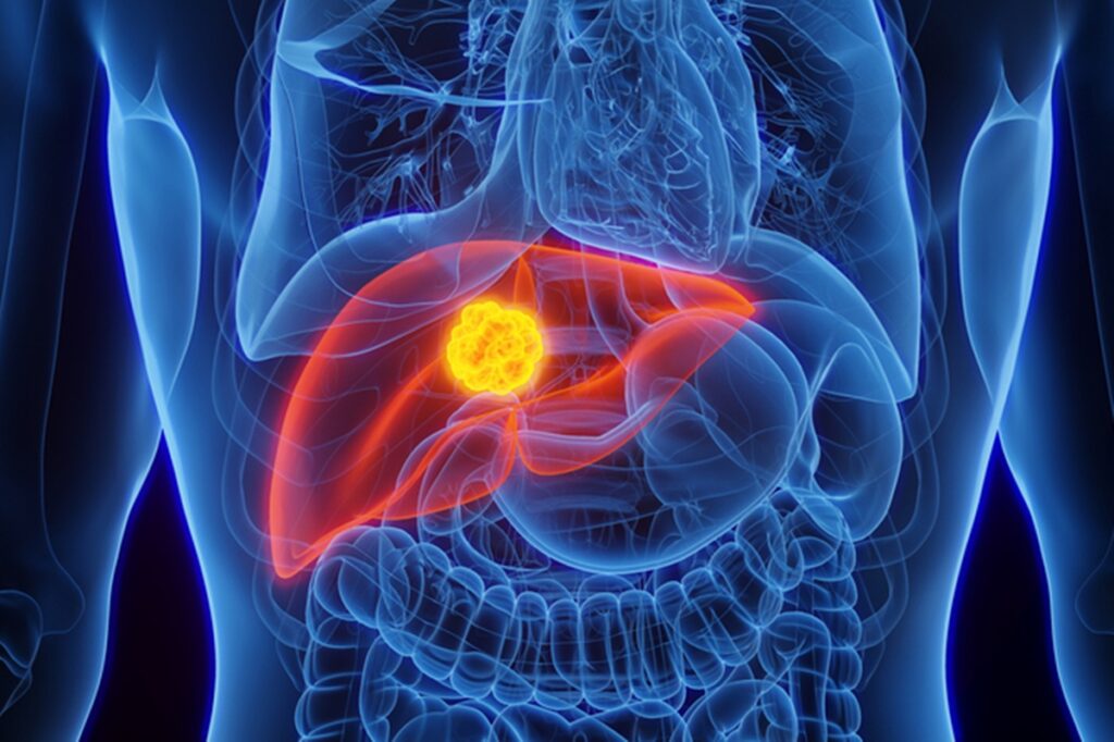 cancer-de-figado:-conheca-as-principais-causas-e-como-se-prevenir