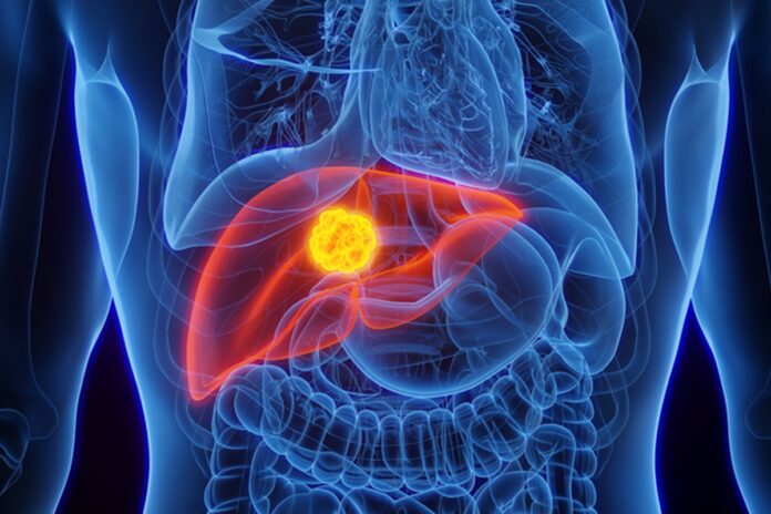 cancer-de-figado:-conheca-as-principais-causas-e-como-se-prevenir