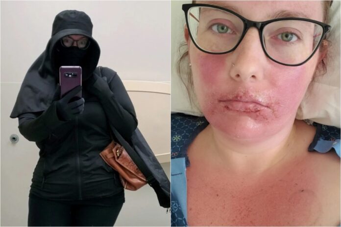 “tenho-que-viver-como-uma-vampira”,-diz-mulher-com-alergia-ao-sol