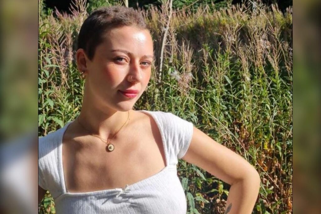 jovem-de-23-anos-perde-todo-o-cabelo-apos-crise-de-estresse-no-trabalho