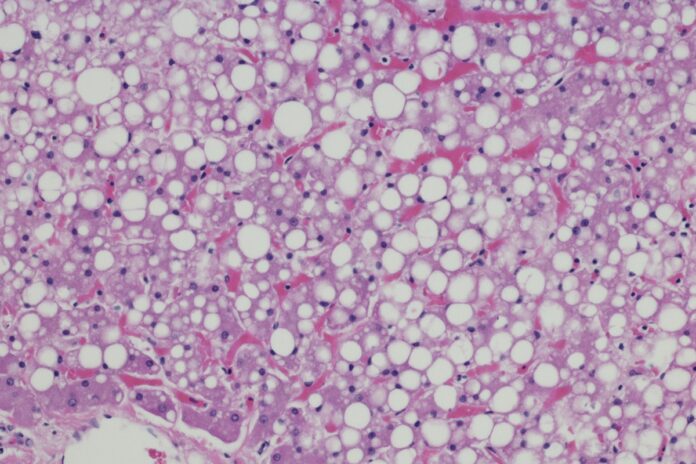 gordura-no-figado:-sintomas-e-como-e-feito-o-tratamento-da-condicao