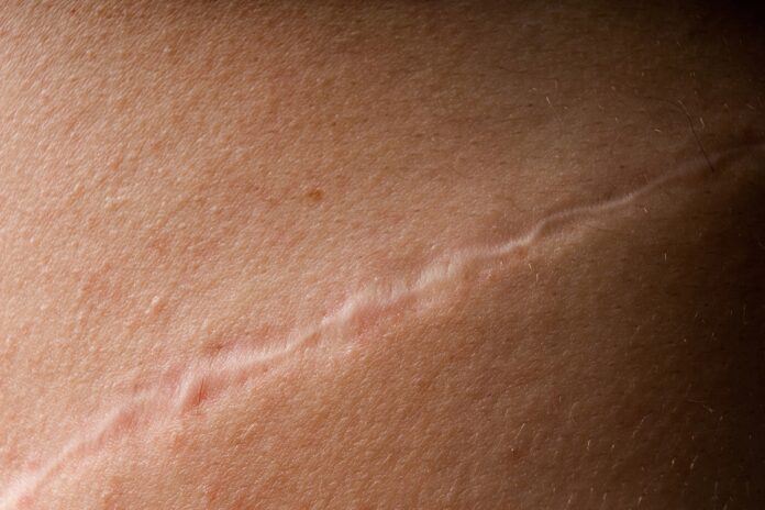 estudo:-proteina-ligada-ao-cancer-ajuda-a-cicatrizar-feridas-na-pele