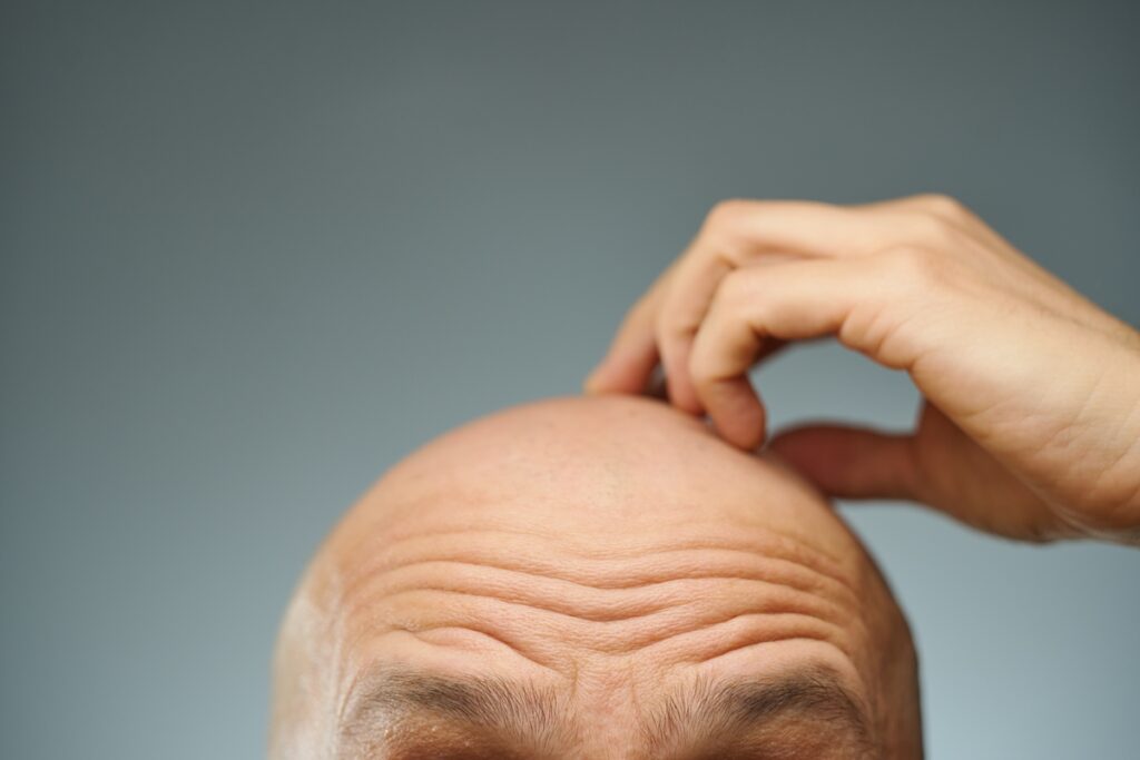 eles-tambem-merecem:-saiba-como-cuidar-da-pele-da-cabeca-dos-carecas