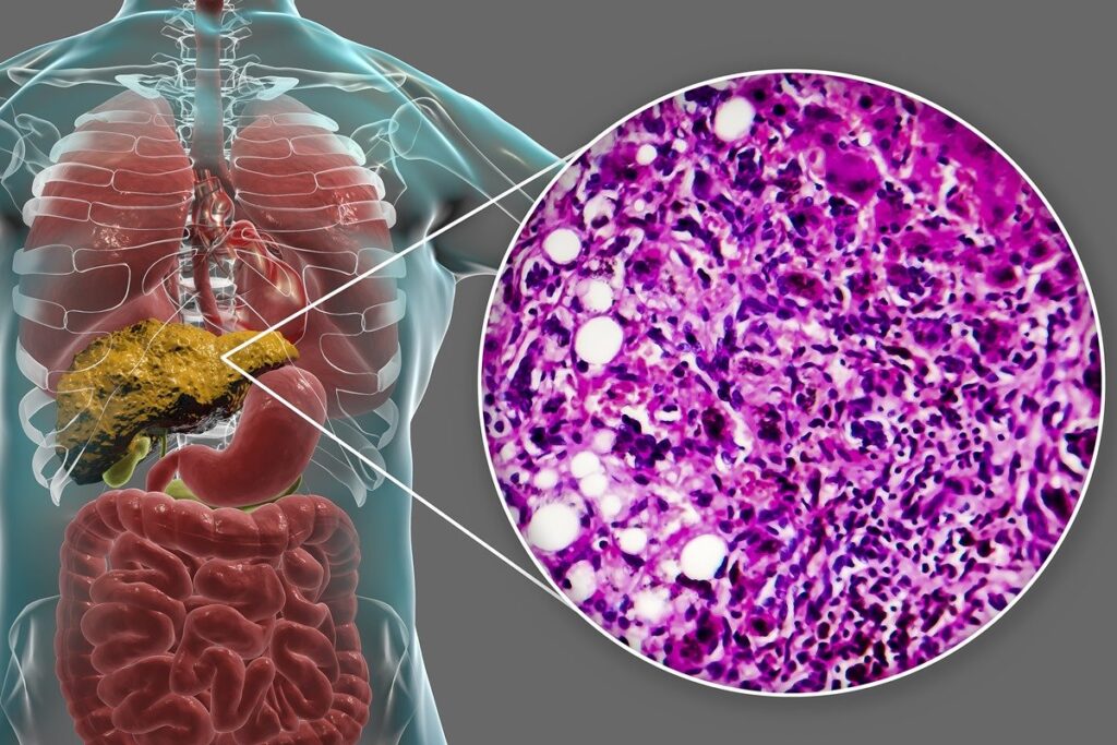 como-a-gordura-se-acumula-no-figado-e-onde-ela-se-instala-no-orgao