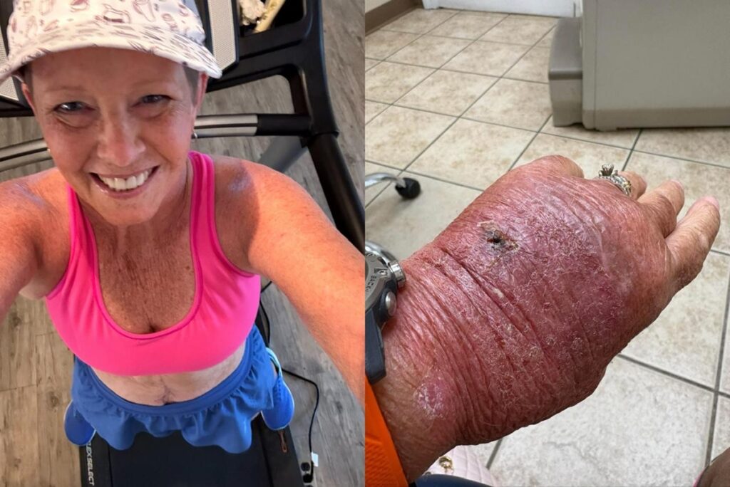 corte-com-papelao-infecciona-e-leva-mulher-de-63-anos-ao-hospital