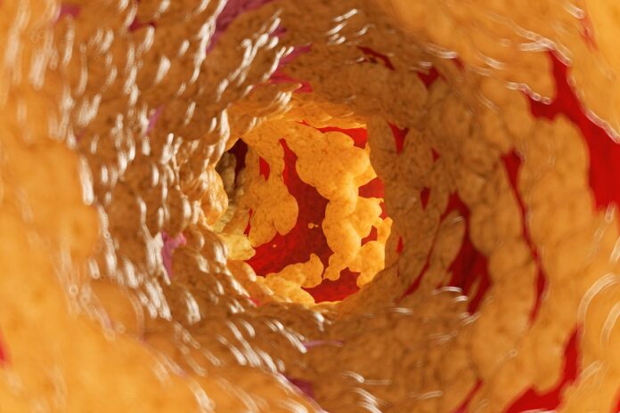 cardiologista-explica-o-que-acontece-no-corpo-quando-arterias-entopem