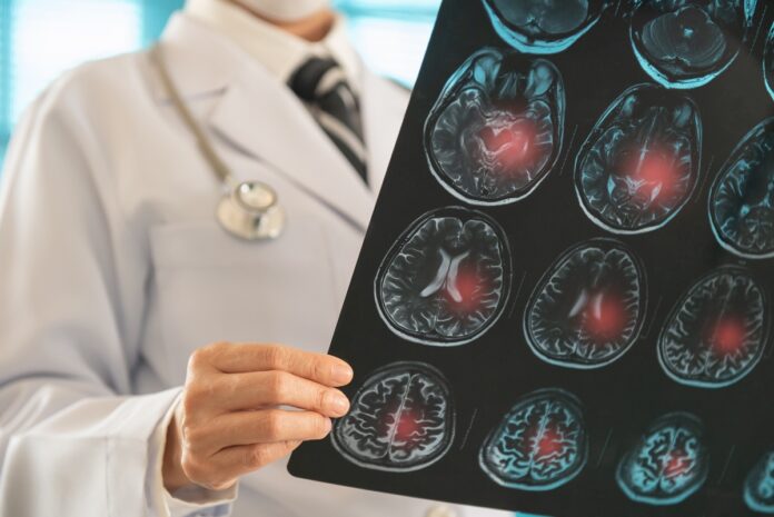 celulas-tronco-podem-ajudar-na-recuperacao-do-cerebro-apos-um-avc