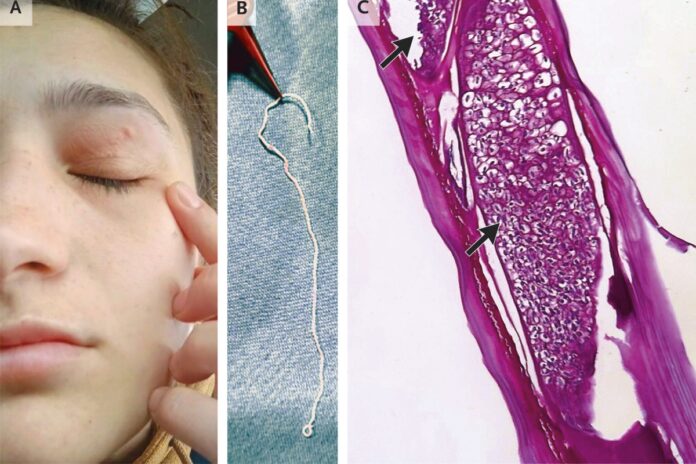 verme-vivo-de-11-cm-e-retirado-da-palpebra-de-mulher-na-romenia