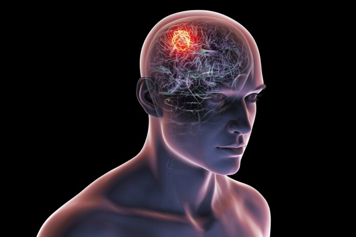 combinacao-de-suplementos-reduz-efeitos-de-tumor-cerebral-agressivo