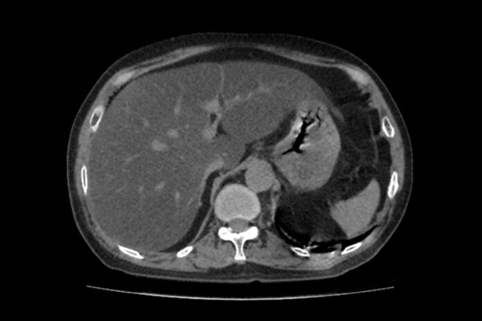 gordura-no-figado:-endocrinologista-diz-qual-e-o-melhor-tratamento