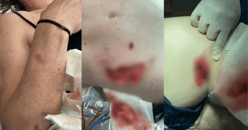 mulher-que-teve-partes-do-corpo-arrancados-por-capivara-se-recupera-em-casa