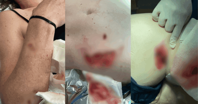 mulher-que-teve-partes-do-corpo-arrancados-por-capivara-se-recupera-em-casa