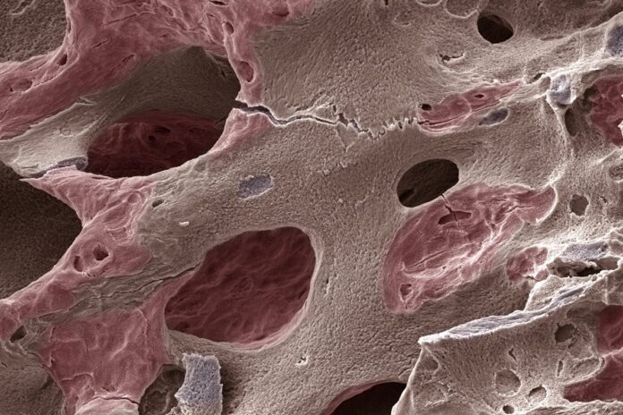 casos-de-osteoporose-devem-disparar-ate-2050,-inclusive-no-brasil