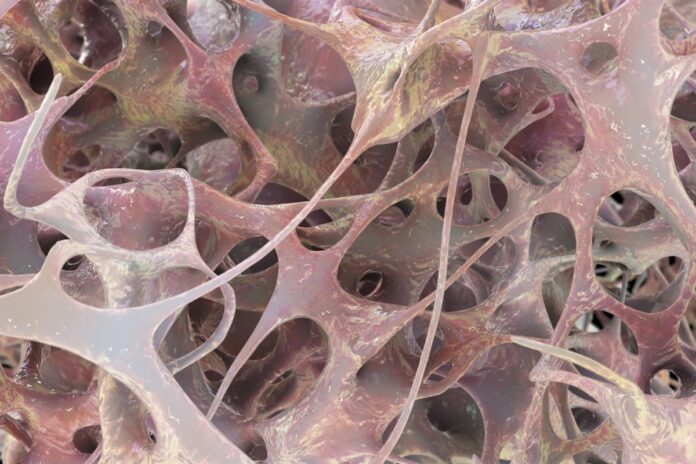 ortopedista-e-fisiatra-listam-os-principais-sintomas-da-osteoporose