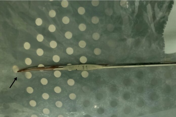 menino-senta-em-agulha-de-croche-e-gancho-torna-cirurgia-um-desafio