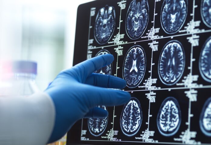 estudo-encontra-sinal-inedito-do-alzheimer-em-exame-de-imagem-comum