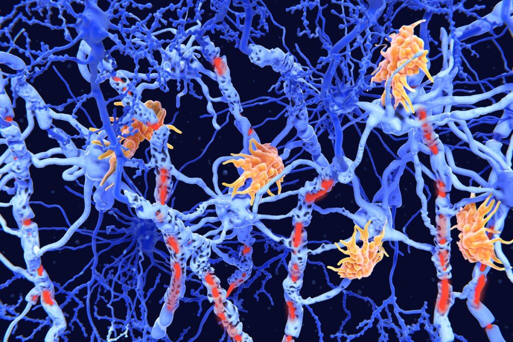 estudo-identifica-2-novos-tipos-de-esclerose-multipla-com-ajuda-da-ia