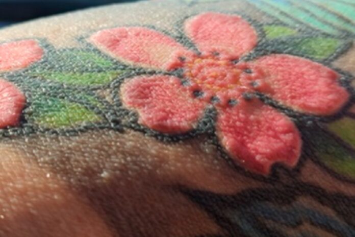 homem-tem-alergia-apos-fazer-tatuagem-vermelha-e-passa-por-7-cirurgias