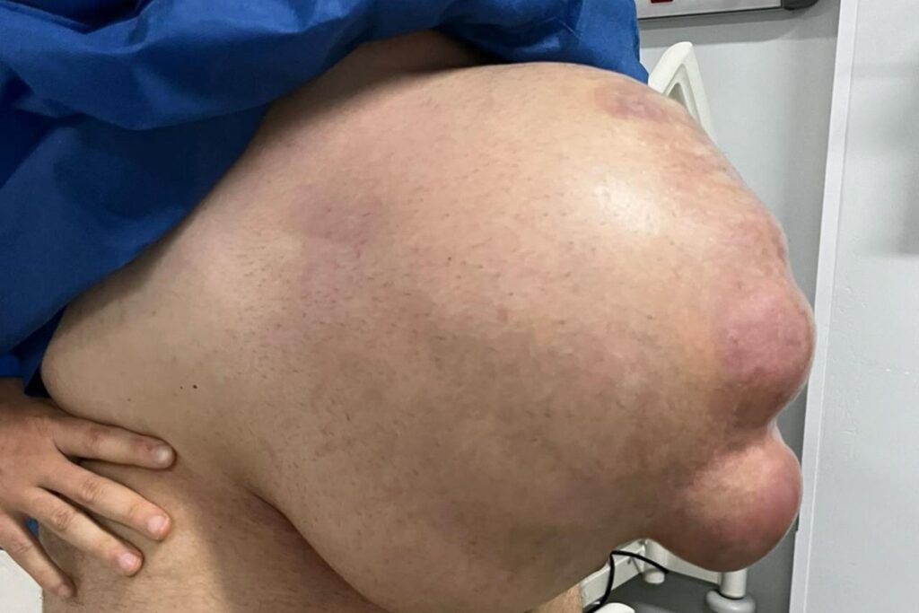 com-hernia-abdominal,-homem-fica-com-barriga-enorme:-“cresceu-em-1-mes”