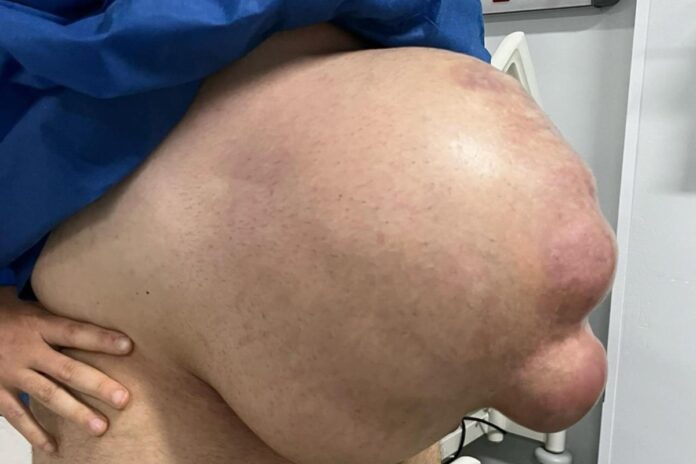 com-hernia-abdominal,-homem-fica-com-barriga-enorme:-“cresceu-em-1-mes”