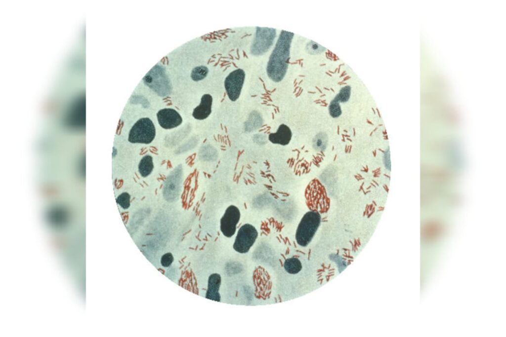 brasil-registra-22-mil-casos-ao-ano-de-hanseniase.-conheca-a-doenca