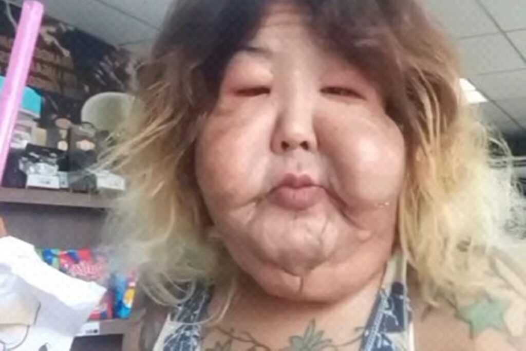 juju-do-pix-faz-nova-cirurgia-para-retirada-de-oleo-mineral-do-rosto