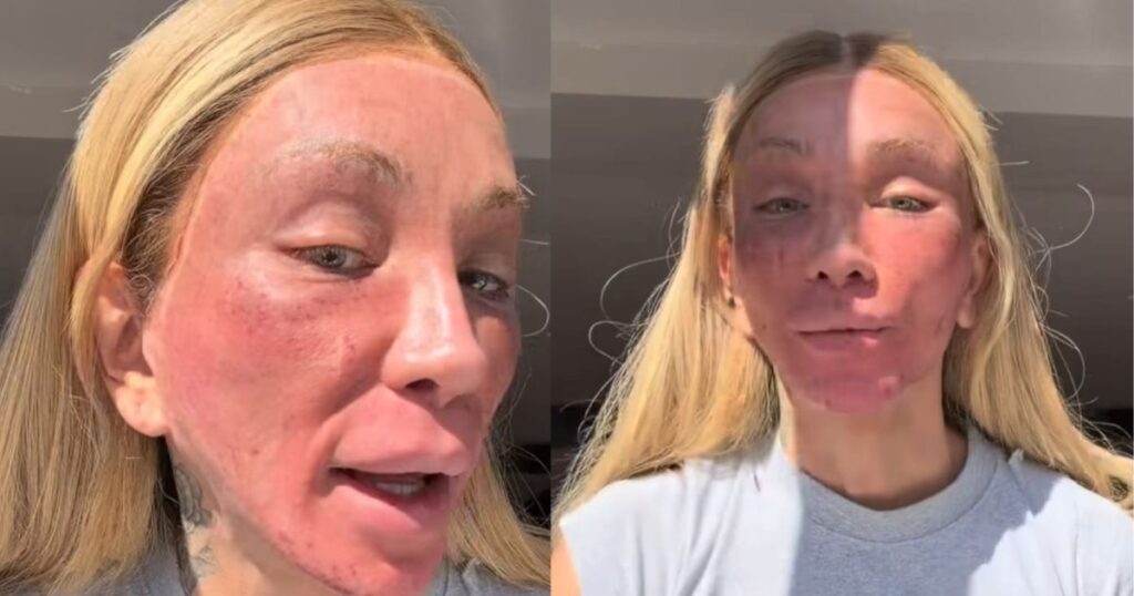 maya-massafera-aparece-com-rosto-alterado-por-peeling-facial-e-choca-web
