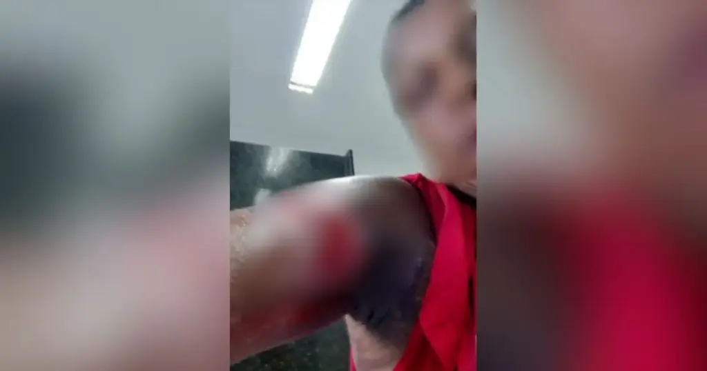 Funcionária será indenizada por se queimar ao fazer batata frita; entenda