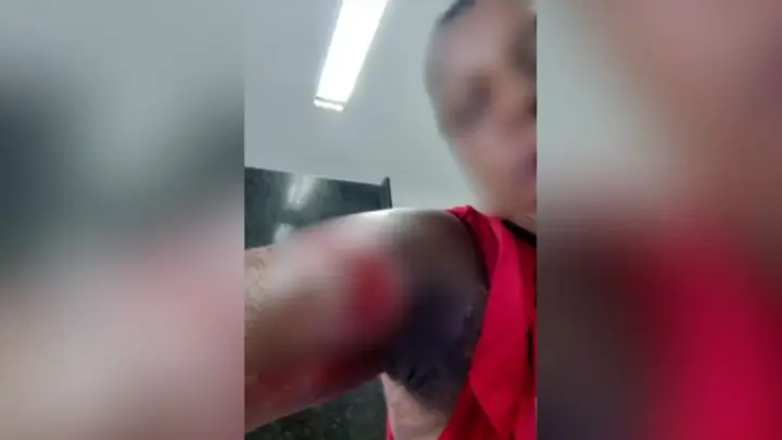 Funcionária será indenizada por se queimar ao fazer batata frita; entenda