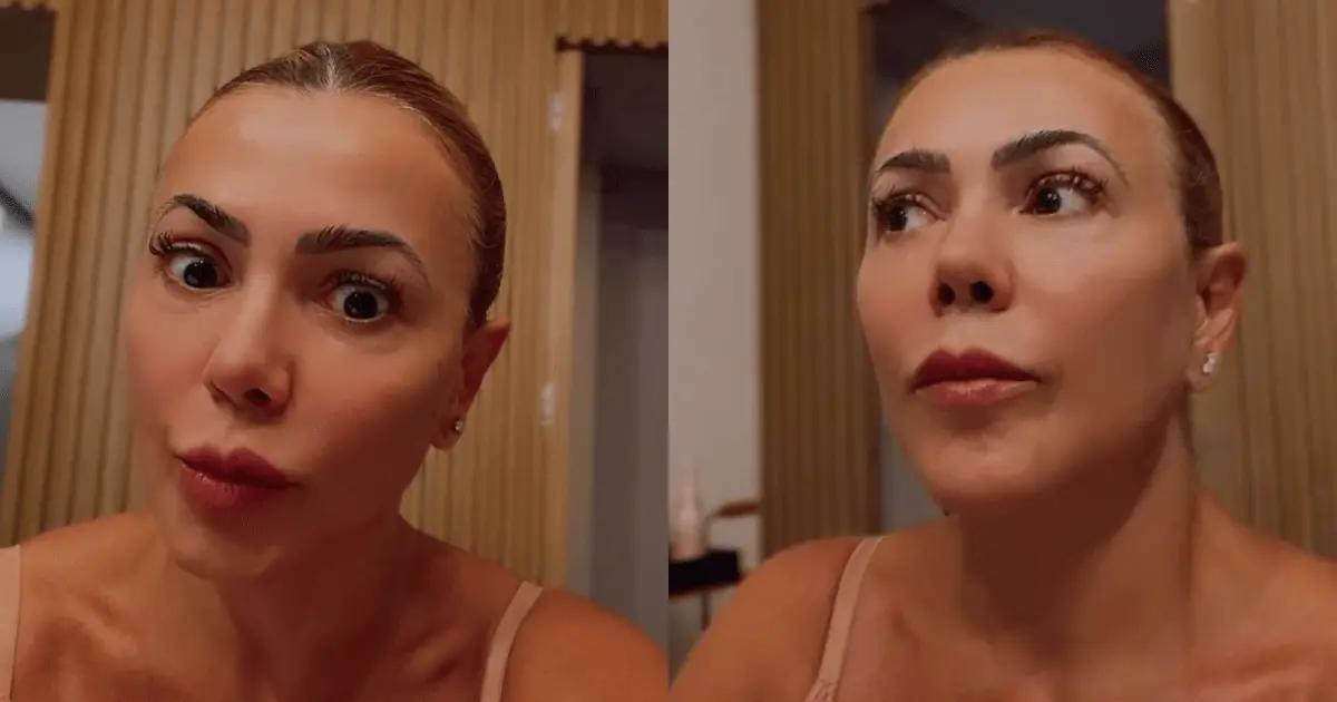 Ex-BBB fala sobre descoberta de cisto no crânio: “Entrei em pânico”